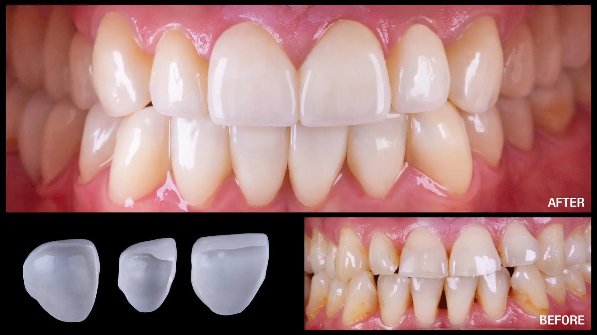 What Is the Difference Between Zirconia and Ceramic Dental Crowns?