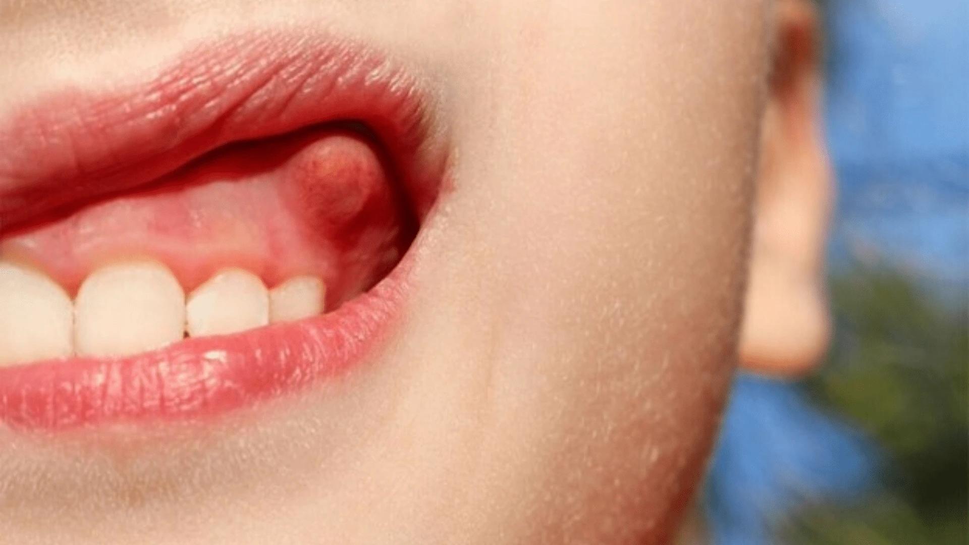 Abscessed Tooth: A Serious Dental Issue That Requires Immediate Attention